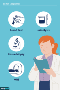 Diagnosing Stage 4 Lupus