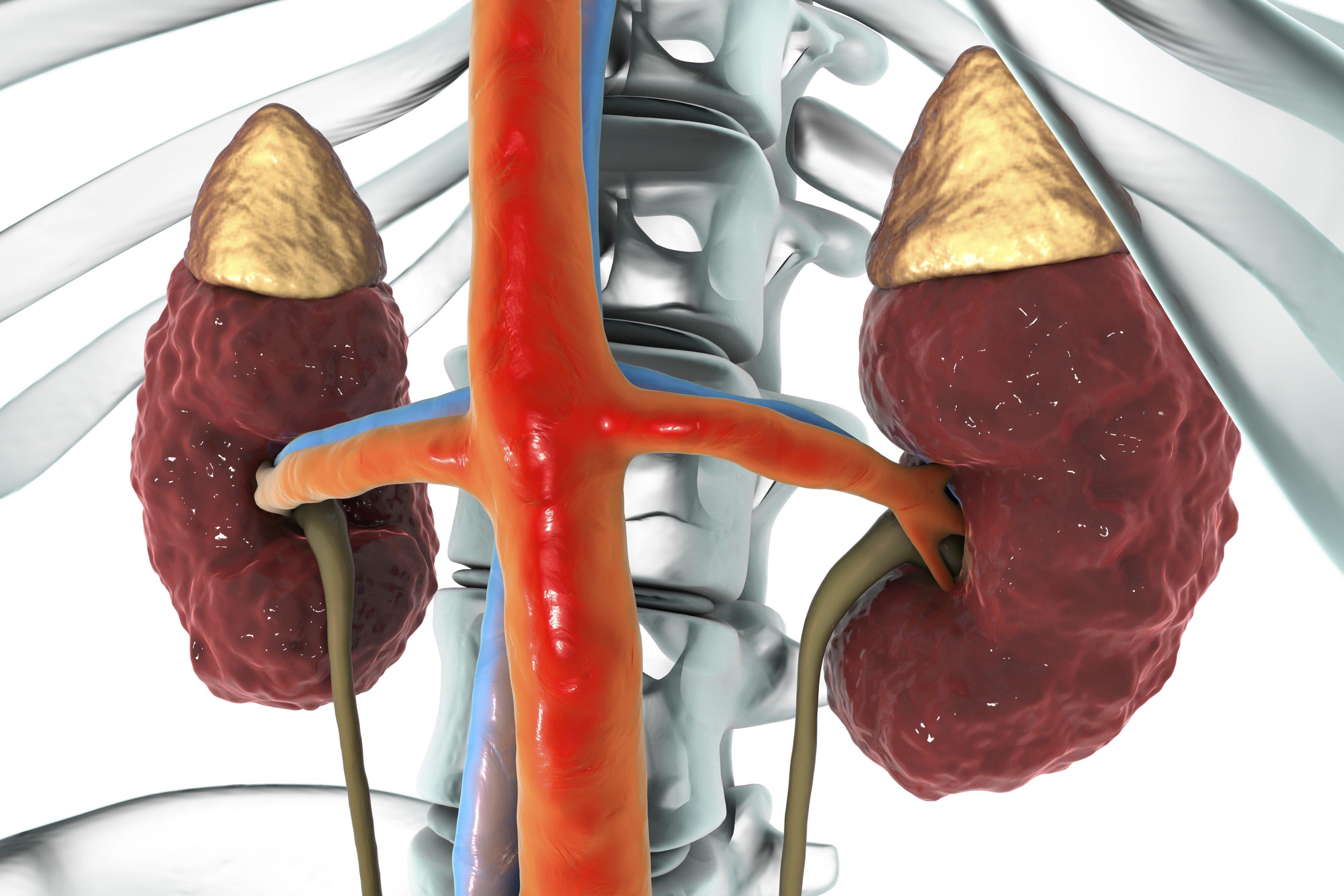 Can Potassium Cause Chronic Kidney Disease 