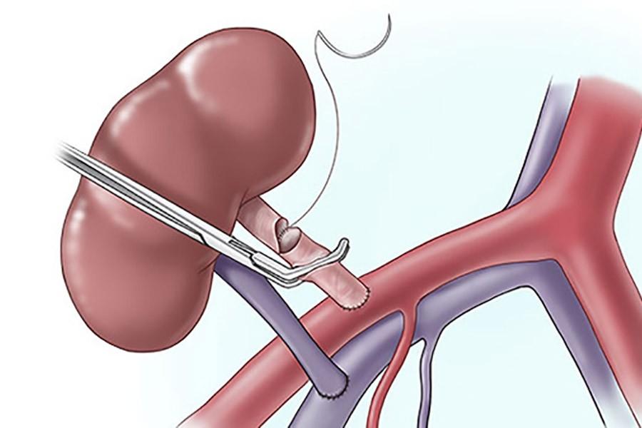 Understanding the Benefits and Risks of Kidney Transplant