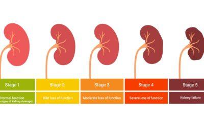 Stage 4 of Chronic Kidney Disease