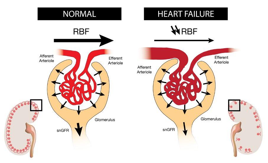 What is Hyperfiltration