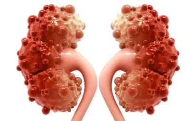 What happens to the body when you have polycystic kidney disease?