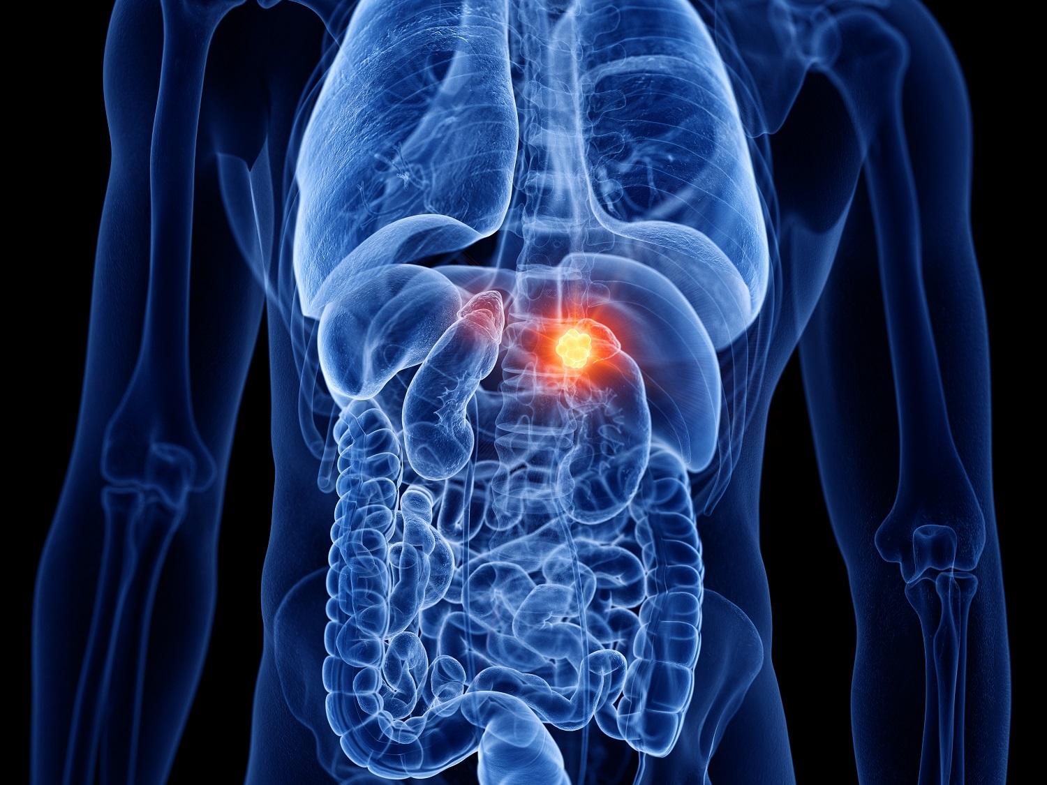 What would cause acute kidney injury