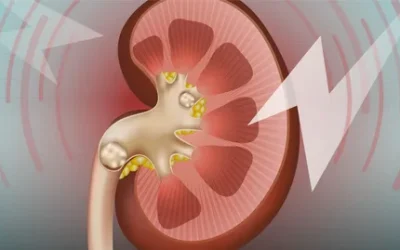 What is a kidney stone (nephrolithiasis)?