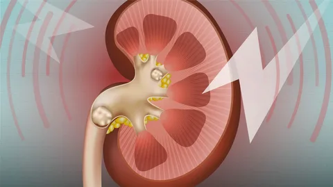 What is a kidney stone (nephrolithiasis)?