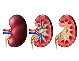 Managing Swelling Caused by Kidney Disease