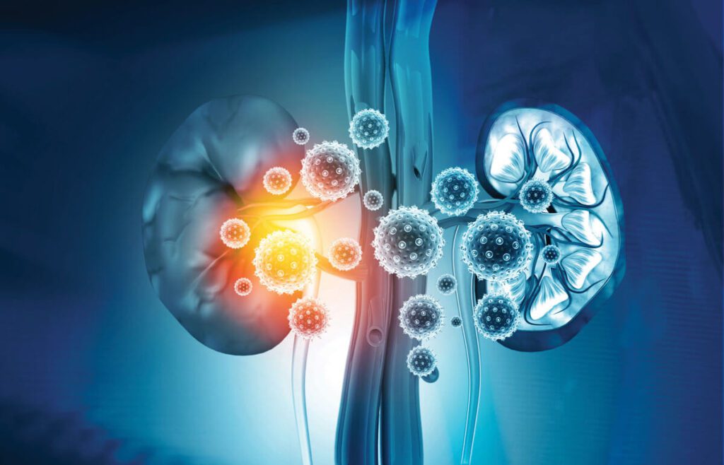 Can people with PKD