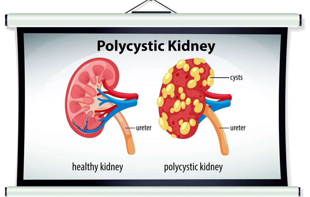 Can people with PKD lead a normal life